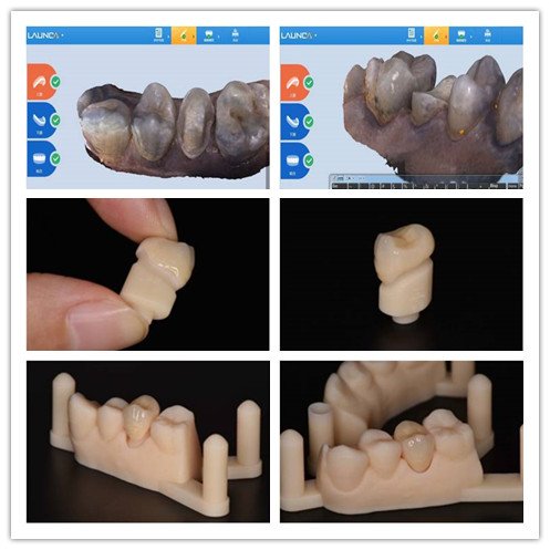 Launca_dental's tweet image. All-ceramic single crown restoration with Launca DL-100 intraoral scanner. Transparency of treatment, no fear, 1.5 hours bringing the perfect clinic experience. Want to win more word of mouth from patients? Let's use Launca intraoral scanner!  #Launca #Orthodontics #implant
