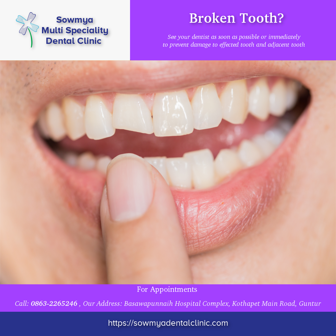 Broken tooth? See your dentist immediately. Appointments sowmyadentalclinic.com/appointment/
#brokentooth #dentist #dentalclinic #dentalstudio #dentistry #dentalemergency #dentalsurgeon #dentalhospital #dentaltreatment #tooth #chippedtooth #damagedtooth #nearme #guntur #dentalimplants RT now