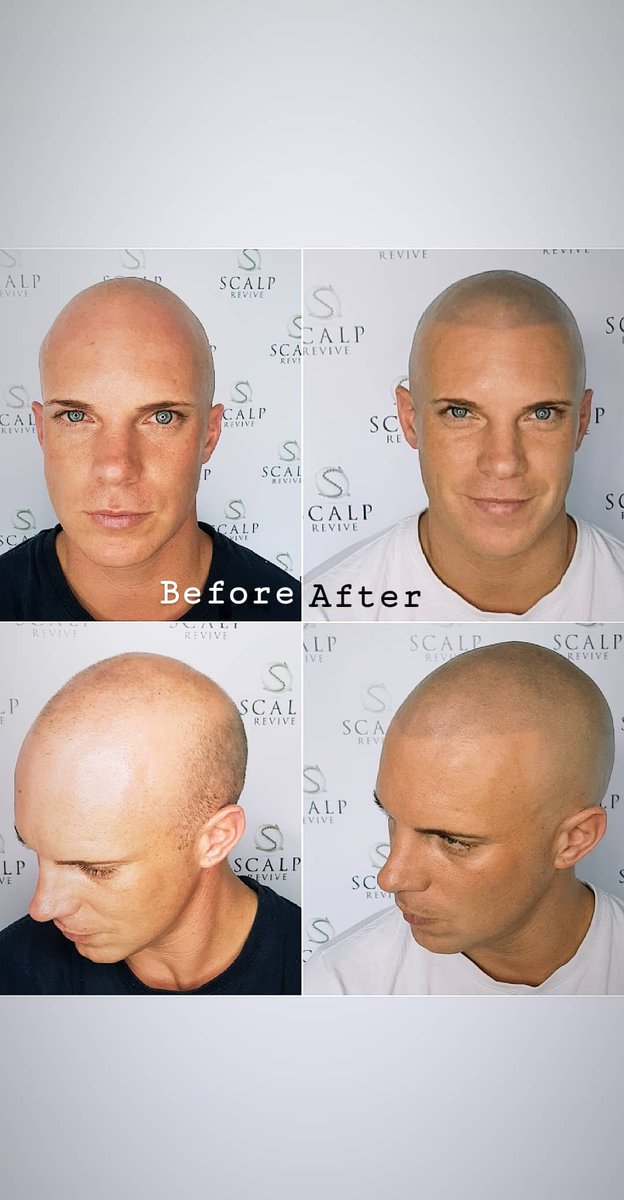 ScalpRevive's tweet photo. Recreate your hairline @scalprevive by one of the very best in the business. Shane Anderson https://t.co/pSRpQkxsZ0