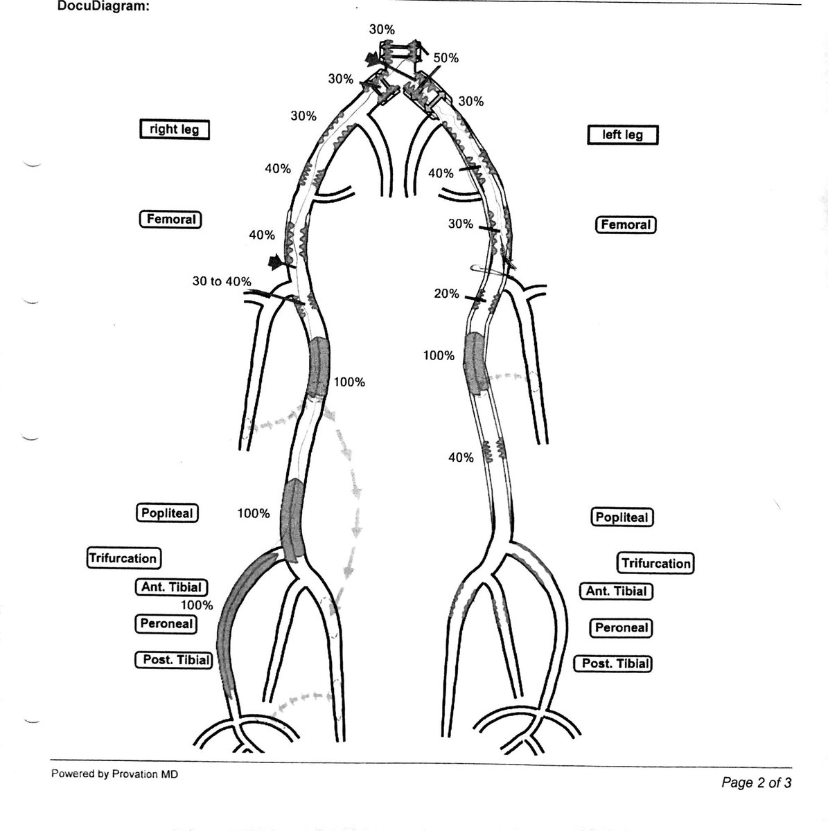 Watts_IR's tweet image. I met a patient yesterday with right leg rest pain, but no tissue loss. She had this US and was told she needed an amputation 😒 A friend referred her to multidisciplinary CLI center @pa_vascularinst and she’ll keep her leg. @CLI_Global will change this! #CLIFighters #MyLegMyLife