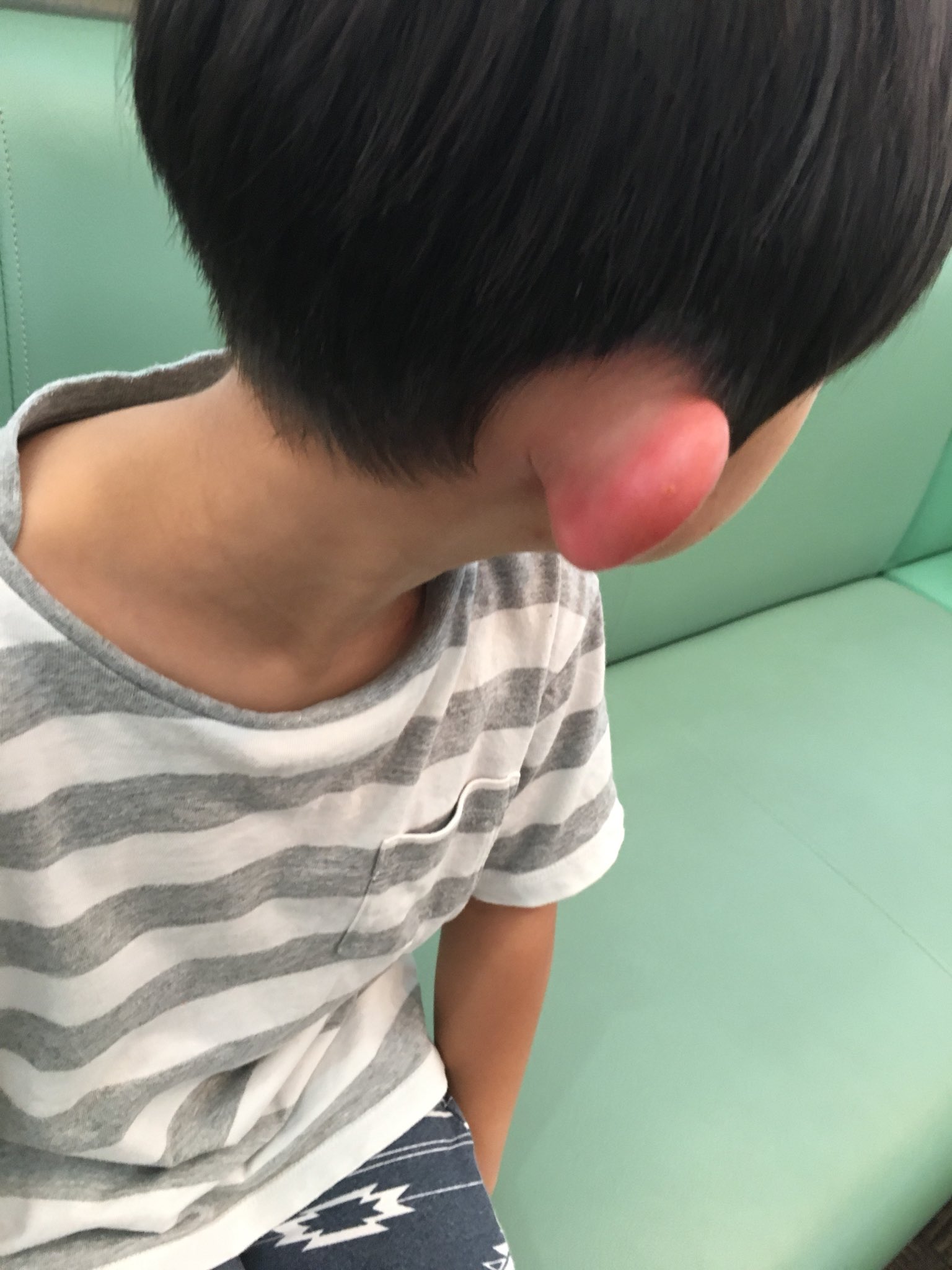 宮村優子さんはtwitterを使っています 耳が急に腫れたかずきんぐ9kさん 虫刺されか炎症か 日曜日やってる病院いって 抗生剤処方されたんだけど 処方箋してる薬屋さんが日曜日あいてるとこ少なくて みつけて行ったけど ほしい薬は在庫なし ぴえーん