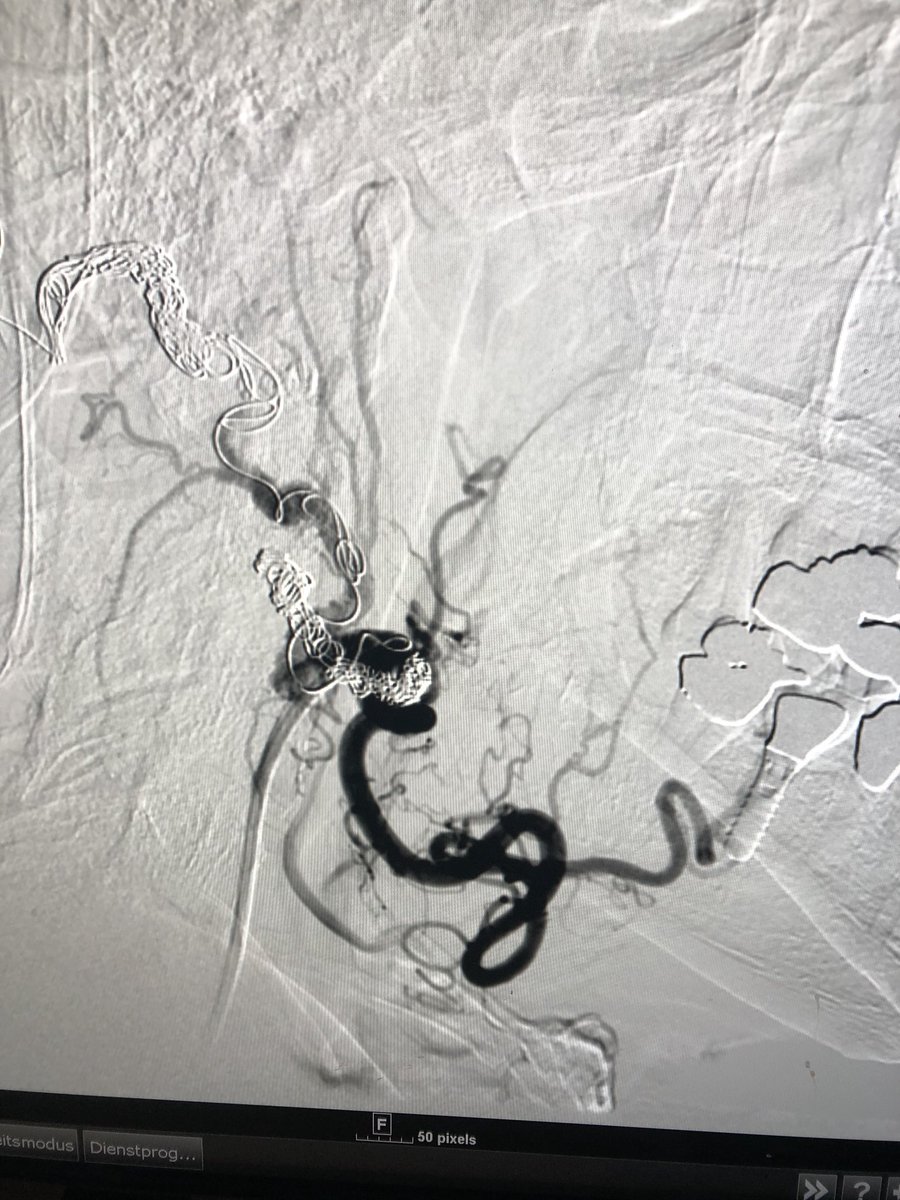 leigov's tweet photo. Vascilar coiling in a patient with unbearable tinnitus https://t.co/hWgA8Q59eo
