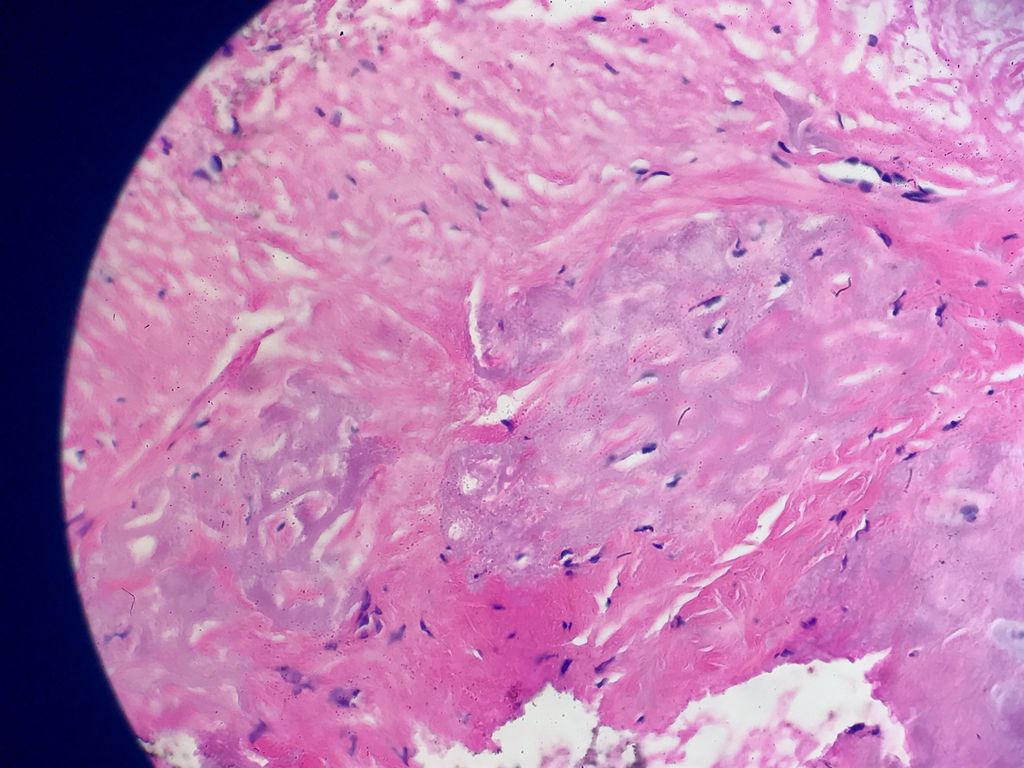Relapsing polychondiritis: 3 clinical criteria + Bx confirmation should be met for a diagnosis: Skin findings are unremarkable (unlike CNH), however, underlying cartilage shows degeneration and mixed inflammatory infiltrate affecting the chondrocytes