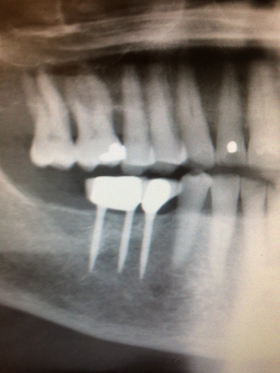 jrmpitt's tweet photo. @teethFAQ @HowardFarran They can work.... https://t.co/4XnYKLJMGP
