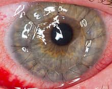 izzatiabdull's tweet photo. Hati Hati girls ! contoh keadaan mata bila kna operate cornea transplant kes contact lens ada kuman and kna infection dkat mata.
Gambar 1 keadaan mata cornea dijahit 
gambar 2 keadaan kelopak mata dijahit nk prevent cornea bocor.

NO MORE CONTACT LENS!!!! https://t.co/wXEolgRBdI