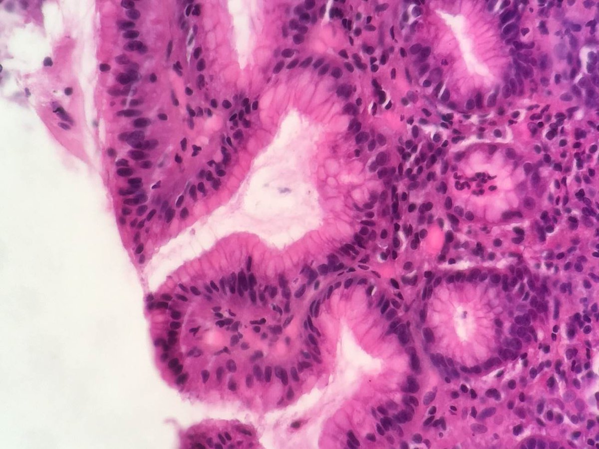 2cAnapath's tweet photo. Biopsie antrale chez un patient ayant consulté pour des épigastralgies. Hématéine-Eosine-Saffran, X400. https://t.co/GDSOXfP2xX
