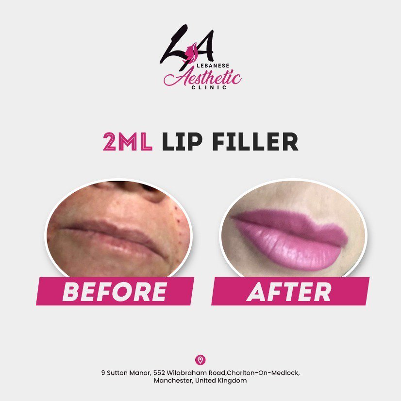 LAClinic_'s tweet photo. 2ML lip filter :) https://t.co/cSofFPVBNb