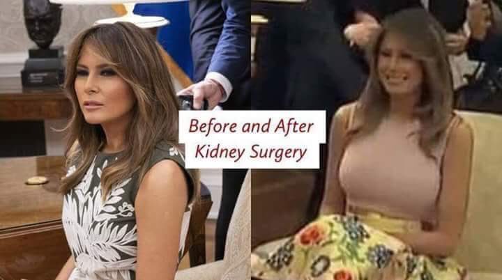 BigBlueWaveUSA's tweet photo. @realDonaldTrump In my ongoing effort to understand & get along with the other side, I would like to congratulate your wife and her medical team on her successful kidney procedure.
#BeBreast #Oops #IMeant #BeBest https://t.co/OCItr2iE44