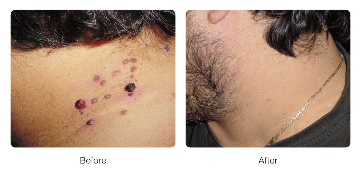 cryopen treatment near me