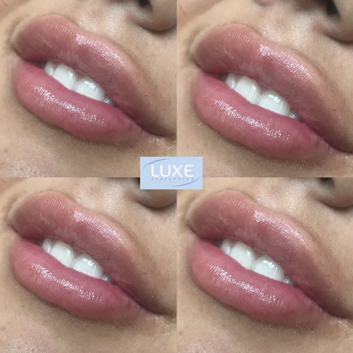 luxeaesthetics's tweet photo. 🔹Luxe Lips🔹#Lips #LuxeLips #lipfillers @luxeaesthetics https://t.co/hgwODX1uLP