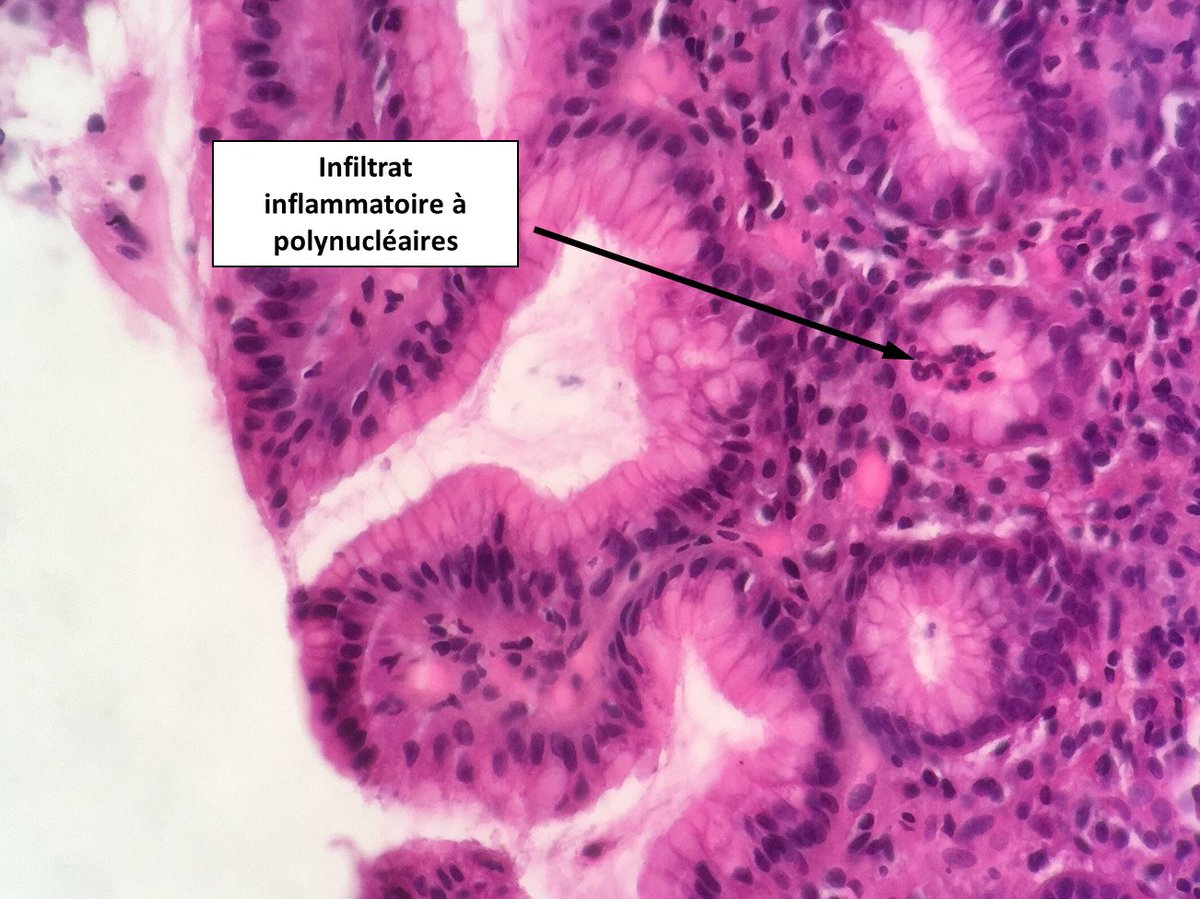 2cAnapath's tweet photo. Infiltrat à polynucléaires: lésions de gastrite
Helicobacter pylori peut être détecté par technique immunohistochimique https://t.co/1LU8L3DLZO