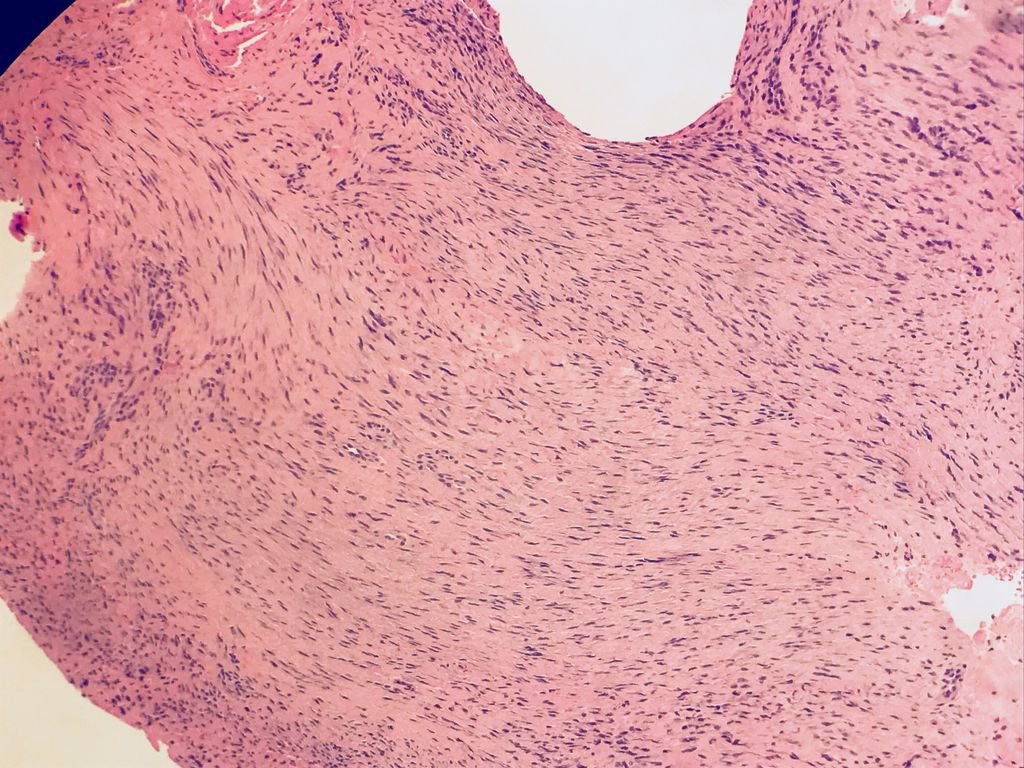 Palmar fibromatosis: