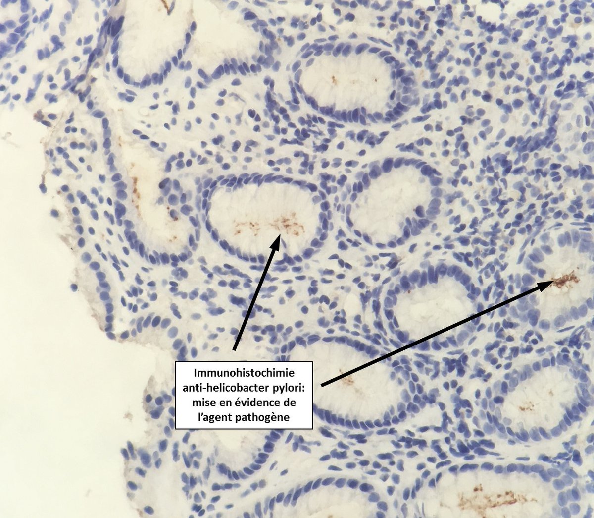 2cAnapath's tweet photo. Infiltrat à polynucléaires: lésions de gastrite
Helicobacter pylori peut être détecté par technique immunohistochimique https://t.co/1LU8L3DLZO