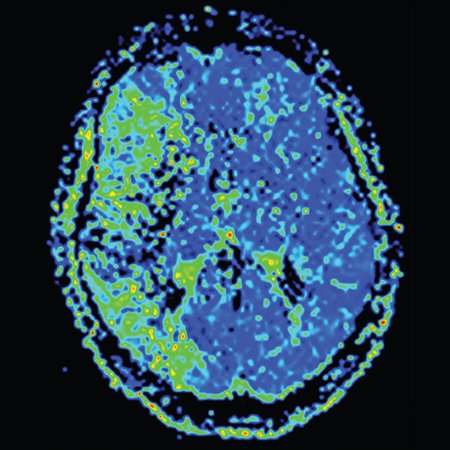JAMANeuro's tweet photo. Does the administration of #dextroamphetamine combined with physiotherapy improve poststroke motor recovery? Hear Larry B. Goldstein, MD, discuss the results of this #rct https://t.co/h511TgEZBi #audio #podcast https://t.co/zlvwaly8E6