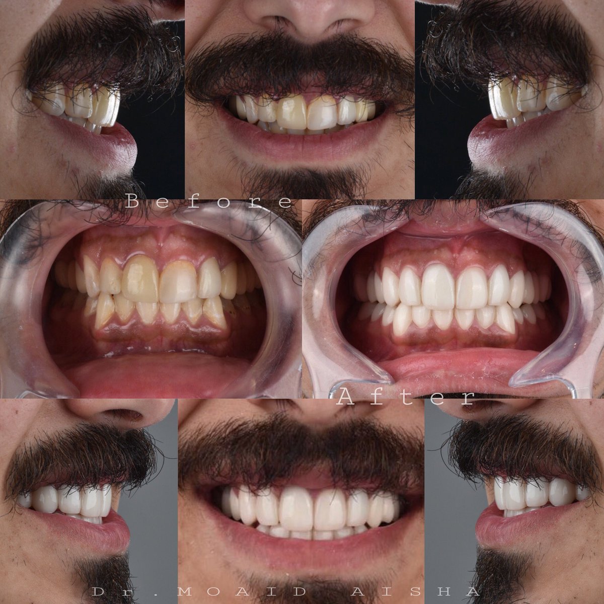 drmoaid20's tweet photo. #اضواء_الابتسامه_لطب_الاسنان_فرع_الازدهار 
#تجميل_الأسنان #تجميل #عيادة_الاسنان #لومنير #فنيرر 
#smiledesign
#cosmeticdentist
#veneer
#dentalclinic #dental 
#lifechanging
#smile
#cosmatic
#retreatment
#dentistry 
#bestclinic 
#drmoaid
#الرياض 
#جده 
#الدمام https://t.co/aYwR1SH2b7