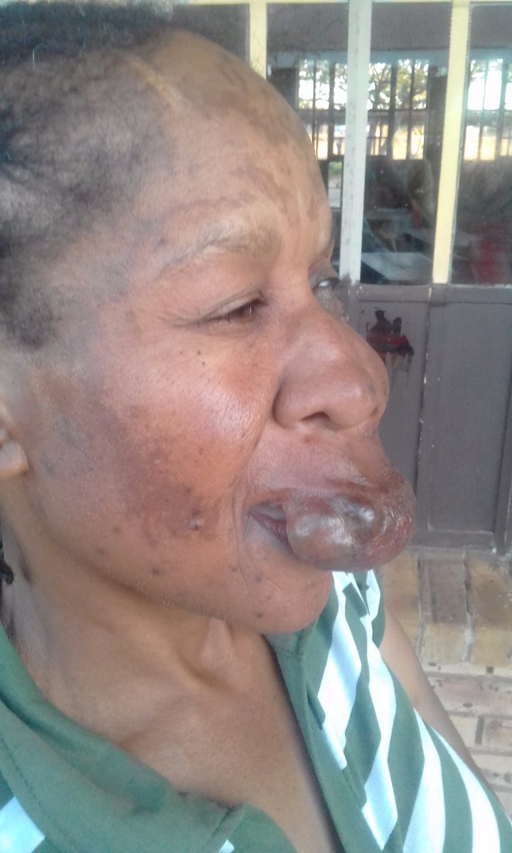 Phuti_Manamela6's tweet photo. Fellow tweeps, meet Mmakobo Mosopa from Hammanskraal, suffering from this surgical condition I cannot even explain. Please RT for awareness, her help could be on your TL.
Her budget for plastic surgery is 0%.Let's  help our mother https://t.co/zuDKltgvfK