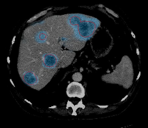 Biomedicores's tweet photo. It is now proven that #livercancer detection and classification based on #optimumhierarchical feature fusion with #PeSOA and #PNN classifier
For more relevant articles visit @ https://t.co/NcAhBBhgi2
Submit your articles @ https://t.co/kg3EmF10D8 https://t.co/kDC7Jo7WdS