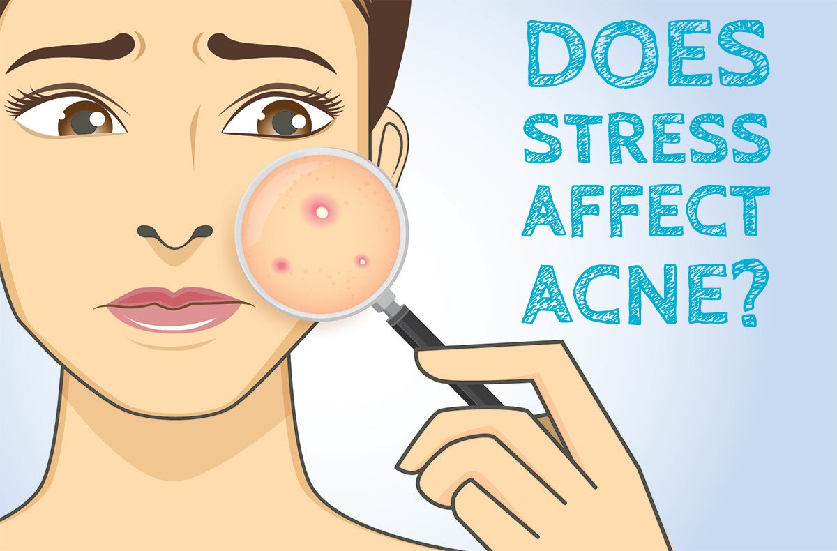 Does stress affect acne? Skin is particularly sensitive to stress. If you feel stressed for a long period of time, consider some life-changes for the sake of your acne as well as your overall well-being. Learn more here: bit.ly/2KYxyKr #Acne