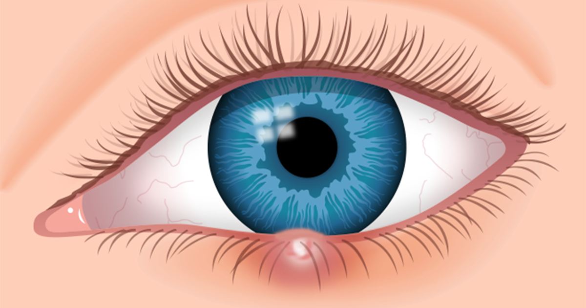 Langtonopt's tweet image. 7 Eye Stye Facts: Identify and Cure Your Stye dlvr.it/Qj5pV4