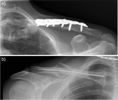 EFORTnet's tweet photo. #Midshaft #Clavicle #Fractures #OptimalTreatment #EFORT #OpenReviews @BoneJointJ article on current #MidshaftClavicleFractures #ManagementConcepts #OperativeTreatment increase #PatientSatisfaction #orthopaedics #surgery #shoulder https://t.co/jqAb0FYIDw https://t.co/QoTukOyPsX