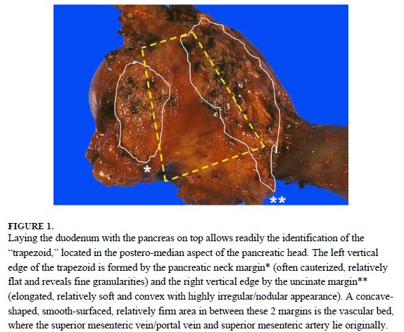 MolecularDoc's tweet image. First year struggles include performing whipple frozens for the first time. I used this article to help orient using the 'trapezoid': vascular bed in the center, panc neck to the left, and uncinate to the right. Picture from the article: ncbi.nlm.nih.gov/pubmed/24451278