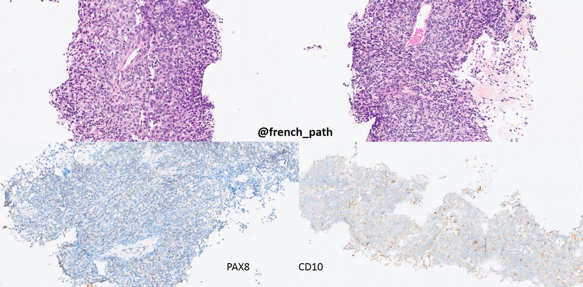 French_path's tweet photo. Hey fellows, first case for me today
F, 69 yo, liver nodule. Hx of endometrial cancer 10 years ago
Any idea? 
What genetic abnormality is associated with this entity?
#GYNpath #pathology @GeronimoJrLapac @GynPath @smlungpathguy @Pathologists @Annpathol @Histopatolomon @UMichPath https://t.co/bpWTOunYQb