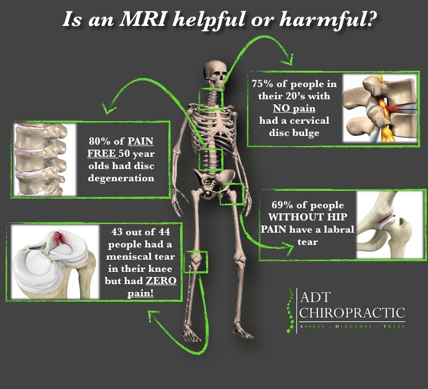 Did you know there is no correlation to the amount of musculoskeletal  tissue damage seen on an MRI and the amount of pain you feel?

You are not always what your MRI tells you and its more often than not worth seeking some physical therapy before opting for imaging or surgery.