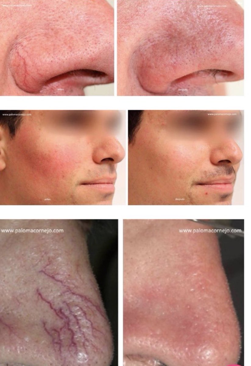 DoctoraLaser's tweet photo. ✔️#couperosis o #cuperosis
La eliminación de la couperosis se realiza con #láser o #luzpulsada. Estos sistemas utilizan el pigmento rojo de la sangre (hemoglobina) para calentar los vasos y destruirlos.
Consúltanos 👉 https://t.co/dagHISIGNU…
#dermatoly #doctoraláser https://t.co/b4mppyNTnA