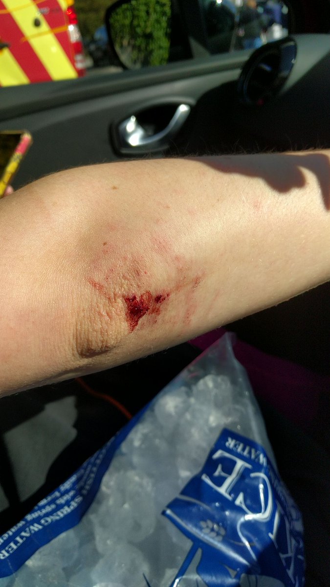 OliCollins27's tweet photo. And with cycling comes the ever present challenge of Katie staying upright #gravityissues #Cairngorms #Scotland
N.b. this isn't the full extent nor the worst of her injuries 🤕🚲🤕 https://t.co/D6kwuv2VkR