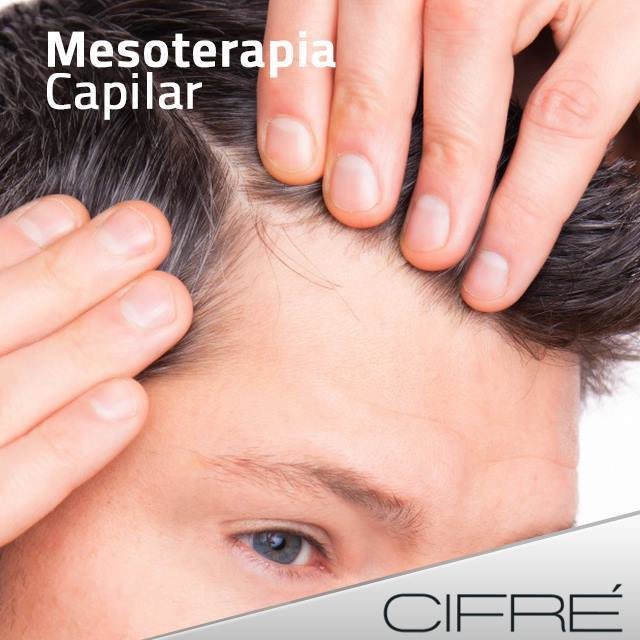Aplicación de micro punturas en la zona afectada de diferentes sustancias que nutren y favorecen el crecimiento o mantenimiento del pelo. #Cifre #Estética #cabello #Mesoterapiacapilar