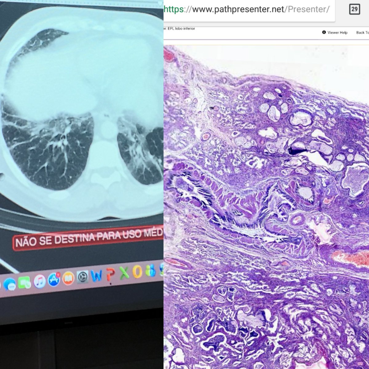 fabiotavora's tweet image. Starting the day with a good interstitial lung disease using @pathpresenter #pulmpath #pulmonarypathology #iamapathologist