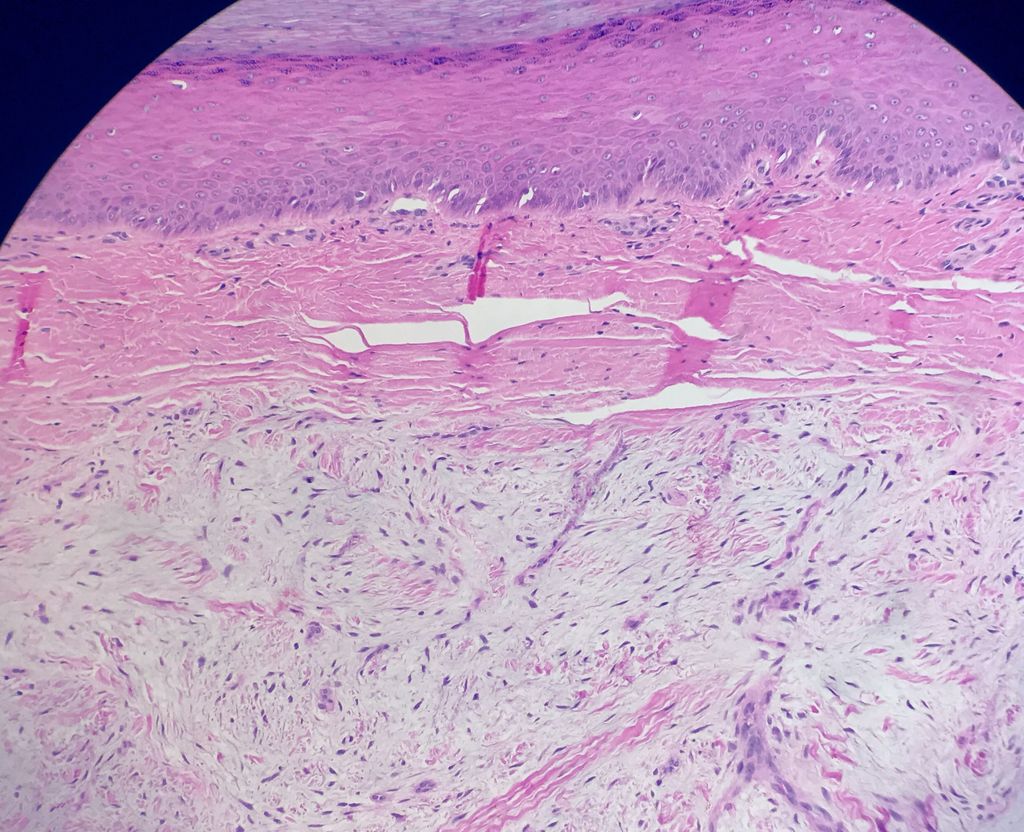 Acral skin, well circumscribed, grenz zone of papilary dermal spairing: Superficial acral fibromyxoma: #Dermpath #Dermpath365