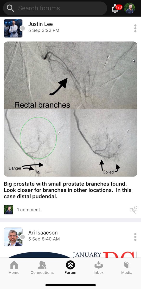 JiggleMed (@jigglemed) on Twitter photo #Live on #jigglemed app Experts from <a href="/SIRspecialists/">Society of Interventional Radiology</a> @ACCCardioEd <a href="/VascularSVS/">Vascular SVS</a> discussing #PAE #FMD #AVMs and other hot topics. Informed. Connected. #Healthcare. #Live on #jigglemed app Experts from <a href="/SIRspecialists/">Society of Interventional Radiology</a> @ACCCardioEd <a href="/VascularSVS/">Vascular SVS</a> discussing #PAE #FMD #AVMs and other hot topics. Informed. Connected. #Healthcare.