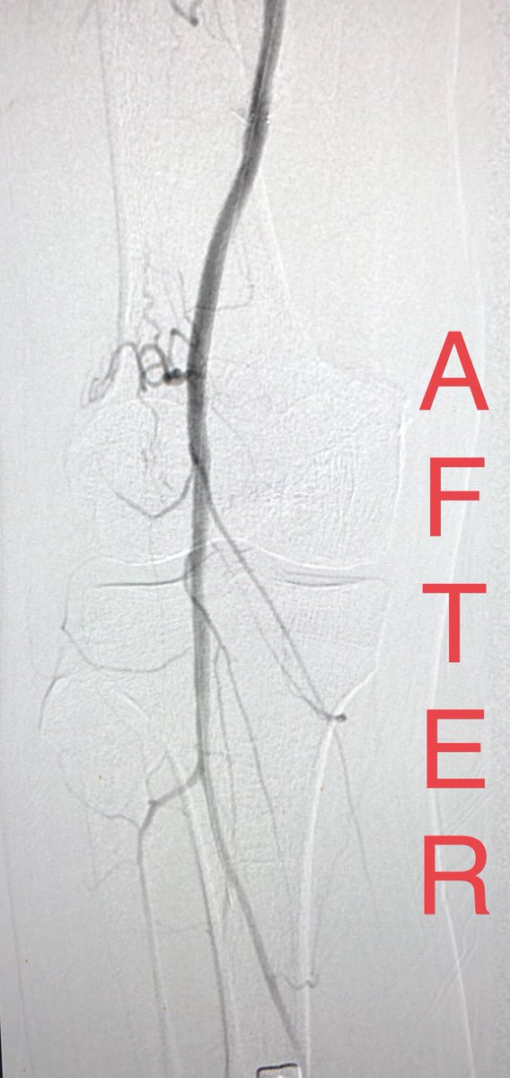 What to do when you can’t get through a distal anastomotic stricture of a thrombosed fem-pop bypass despite lysis? Just open up his native SFA! Special thanks to my fellow, Yusuf @yhkarrar ! <a href="/UICOMPRadiology/">UICOMP Radiology</a> <a href="/SIRRFS/">SIR RFS</a> <a href="/SIRspecialists/">Society of Interventional Radiology</a> @