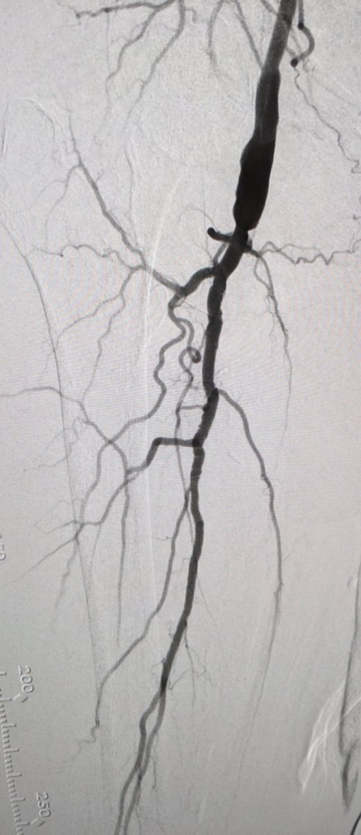 LessneVIR's tweet photo. My preferred sequence when treating octogenarian patient with shin ulcer: revasc SFA #CTO w #PTX &amp; #DCB, get ABI 0.39->0.79, see pt w ulcer nearly healed 1mon later, get hug #CLIFighters @CLTRadiology #IRad https://t.co/PF14VBpiOO