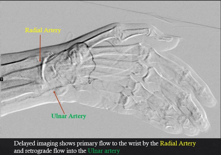 kmadass's tweet photo. Imp esp for trainees &amp; any1 working in the arm->High Radial Takeoff must be considered on every angio to prevent complications! @SIRRFS @SIR_ECS @rkryu @LessneVIR @SDhandMD @keithppereira @AlexCVIR @SOBE_Vascular @Watts_IR @DanHan @shishem @Vascularman @ahmed_kamel_ir @ajgunnmd https://t.co/skZI05h9hk