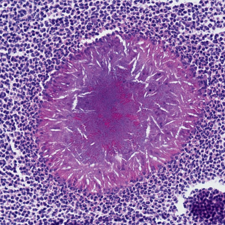 NEJM on Twitter "New Image Challenge What's the diagnosis? Read the