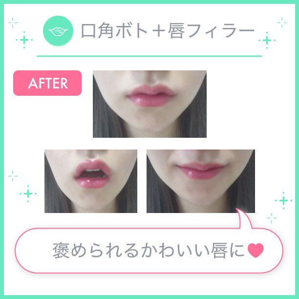 トリビュー 美容医療 整形の口コミ予約アプリ ぽんちゃんさんの口角ボト 唇フィラー 元々は口角が下がった 薄い唇でした 真顔でもかわいいm字リップになり大満足です お化粧が映えるようになりました 友人にも褒めてもらえます トリビュー 美容医療 整形の口コミ予約アプリ ぽんちゃんさんの口角ボト 唇フィラー 元々は口角が下がった 薄い唇でした 真顔でもかわいいm字リップになり大満足です お化粧が映えるようになりました 友人にも褒めてもらえます