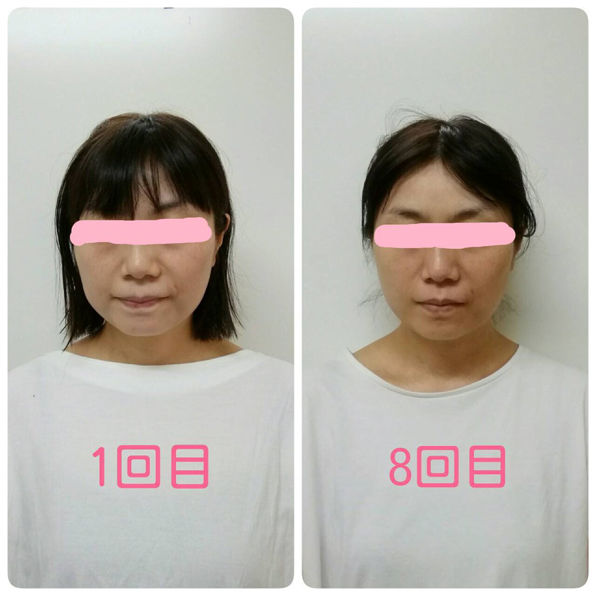 西葛西トータルビューティーサロンダブルルーツの矢崎健太郎 Auf Twitter 体重は増えたのに痩せた って言われてしまう小顔 矯正 週1で30分の小顔矯正に来ていただいているお客様の8回目の変化 ダブルルーツ 西葛西 小顔矯正 ダイエット 西葛西トータルビューティーサロンダブルルーツの矢崎健太郎 Auf Twitter 体重は増えたのに痩せた って言われてしまう小顔 矯正 週1で30分の小顔矯正に来ていただいているお客様の8回目の変化 ダブルルーツ 西葛西 小顔矯正 ダイエット