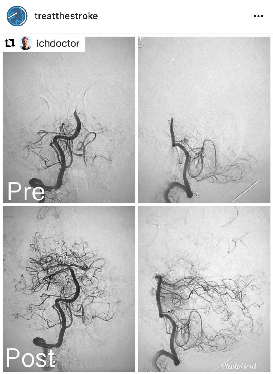 #ThrombectomyThursday - #Repost from our colleague <a href="/chriskellnerMD/">Dr. Christopher Kellner · NYC Neurosurgeon</a> <a href="/MountSinaiNeuro/">Mount Sinai Neurosurgery</a>, aspiration thrombectomy of a distal basilar occlusion with a single-pass via right transradial approach to avoid the dissection. TICI 2B (persistent left SCA occlusion). instagram.com/p/BnrYeSEhdfd/…