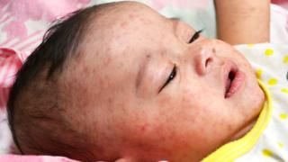 globalacademyhs's tweet image. #Measles cases hit record high in Europe 

#WHO #infections #hepatitis 

buff.ly/2N0lMRu