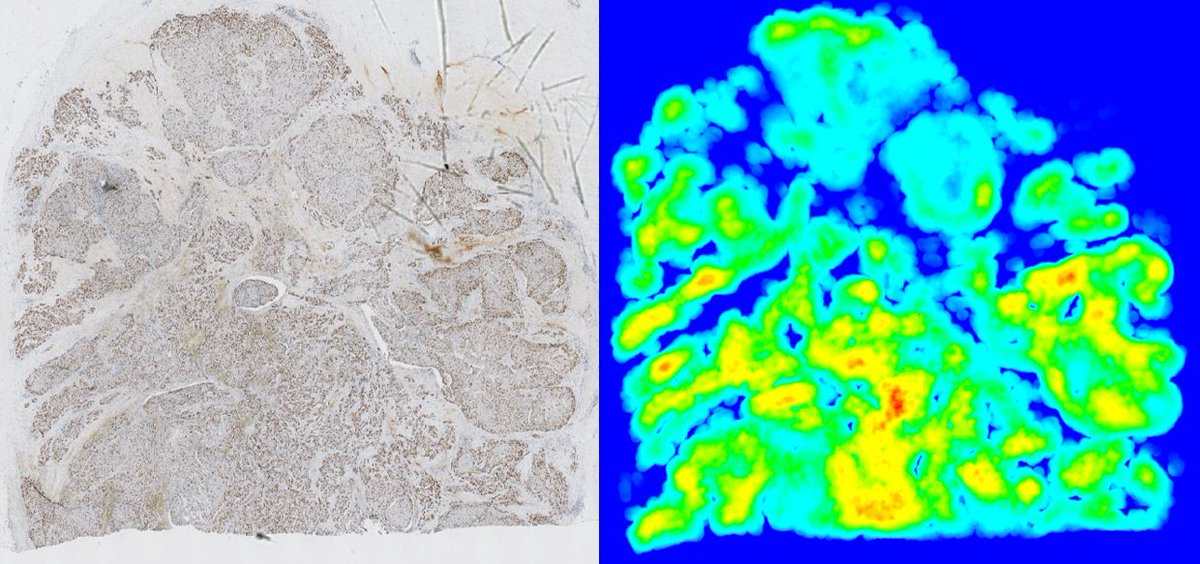Visiopharm's tweet photo. Visit us at booth 21 from September 9-11th at #ECP2018 to see our presentation on Ki67 Hot Spot Detection & experience @hamamatsu whole slide scanning live! Check out our Ki-67 Hot Spot Detection APP here: https://t.co/COP5v8obiQ #cancerresearch #imageanlysis #digitalpathology https://t.co/gAeLcoAHYF