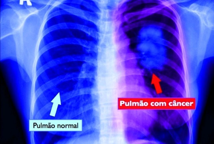 maltanet's tweet photo. Santa Casa de Maceió: Confira quem pode fazer o TCBD para prevenir o câncer de pulmão
https://t.co/qPnGLEnYmS https://t.co/02InUwSHes