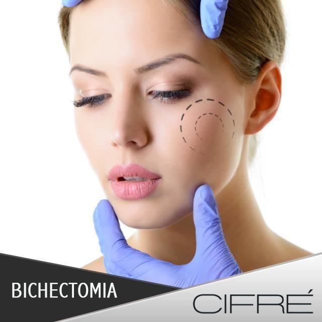 Es un procedimiento que se utiliza para mejorar el contorno facial por medio de la disminución de las mejillas al retirar las bolsas de grasa llamadas, las bolsas de Bichat. Es una cirugía ambulatoria que dura un tiempo aproximado de 10 minutos. #cifre #belleza #salud