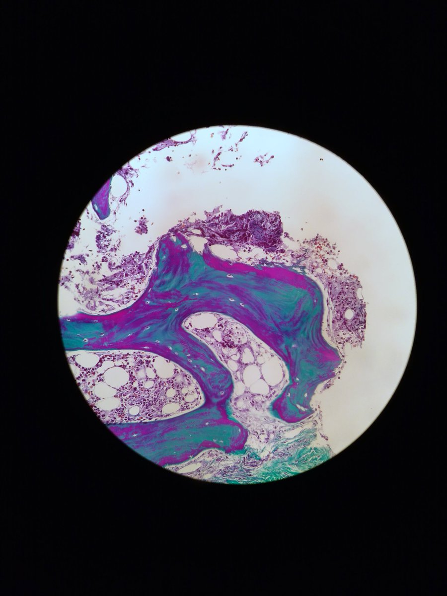 CQuadrosMD's tweet photo. When you start hematopathology and you see these colours 🙌😍 (masson trichrome in bone marrow biopsy) 

#pathology #colours #Ciencia #ilovemyjob https://t.co/Cb3ZBAYy0I
