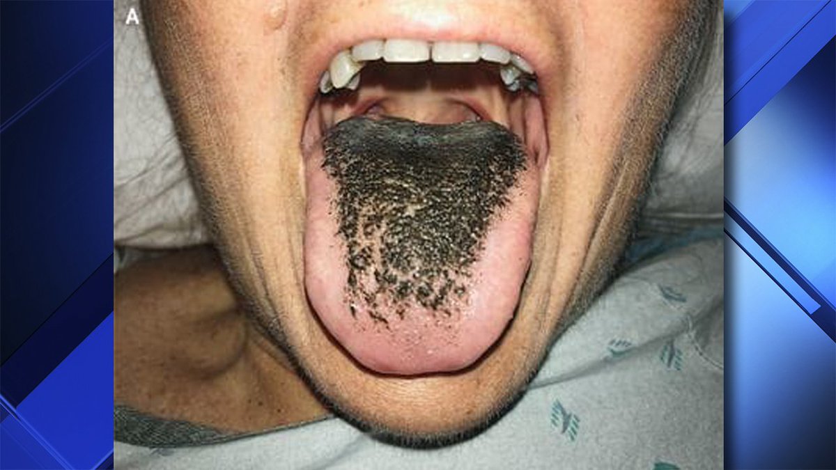 "Black hairy tongue" is real and it's so gross bit.ly/2M7WTlA?utm_so… https://t.co/JEUCsLQ0rK