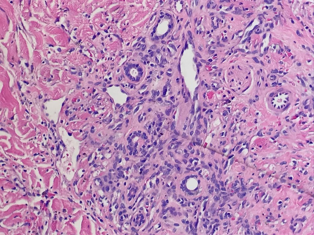 DermpathMGH (@dermpathmgh) on Twitter photo proliferation of irregular vascular channels partly surrounding preexisting vessels in some areas.classic appearance is of small vessels protruding into an abnormal vascular space="promontory sign": Kaposi sarcoma #Dermpath365 #Dermpath <a href="/DrPatrickRush/">Patrick Rush</a> <a href="/RosNazarianMD/">Rosalynn Nazarian MD</a> <a href="/LynDuncanMD/">LMD</a> proliferation of irregular vascular channels partly surrounding preexisting vessels in some areas.classic appearance is of small vessels protruding into an abnormal vascular space="promontory sign": Kaposi sarcoma #Dermpath365 #Dermpath <a href="/DrPatrickRush/">Patrick Rush</a> <a href="/RosNazarianMD/">Rosalynn Nazarian MD</a> <a href="/LynDuncanMD/">LMD</a>