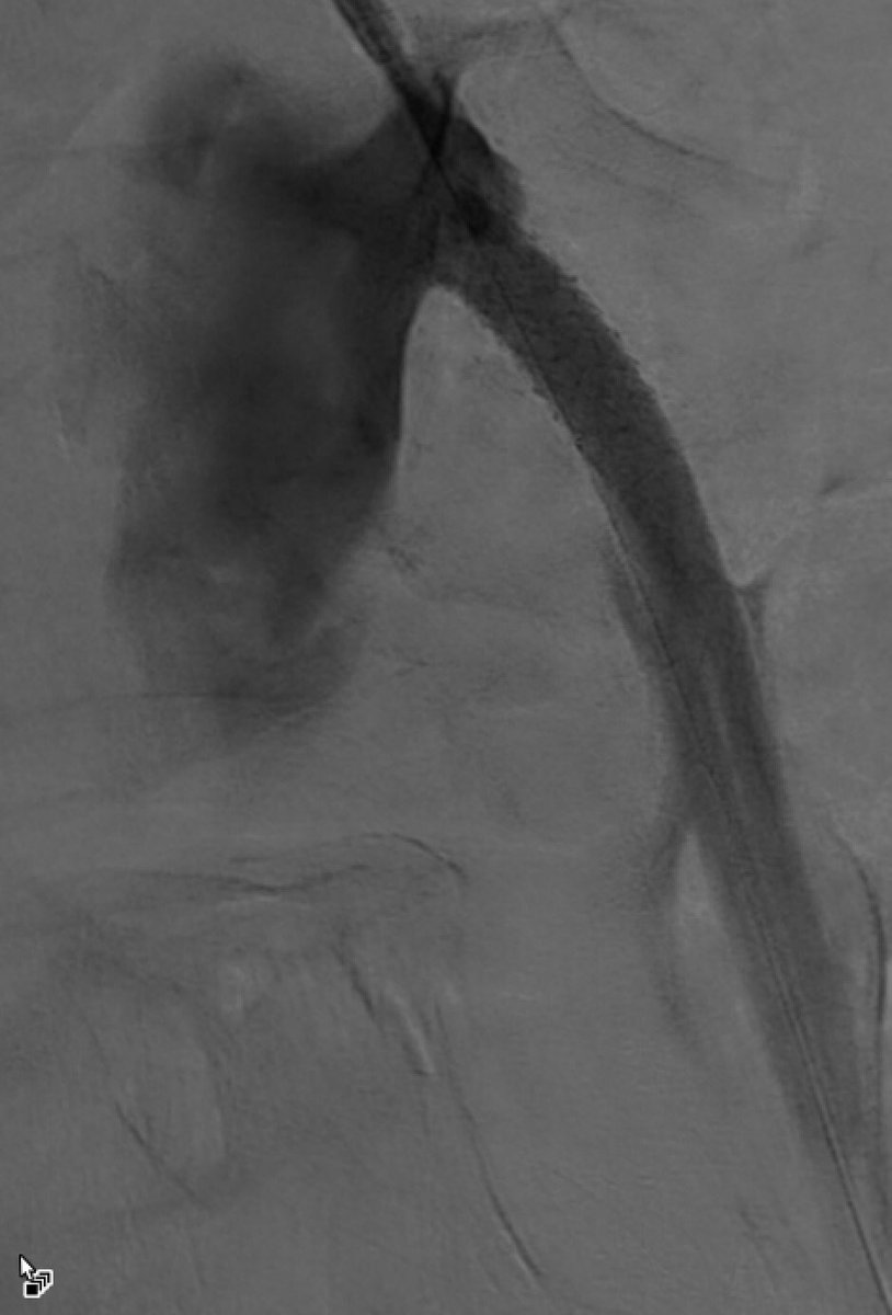 ManuSinghMD's tweet photo. Putting all of my @MountSinaiIR skills to work to help this patient with abdominal angina and weight loss. #iRad can stent through #pinhole in the wrist. #RadialFirst #miips #notouch 
@AlanBirneyMD @prat_shuk @MarcinKolber @MCristMD https://t.co/3zdT7H9ghr