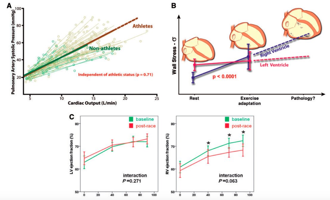 gonzaeperez's tweet photo. #Corazón de Atleta y riesgo de Arritmias
El ejercicio impacta sobre Ventrículo Derecho
-Dilatación, ⬆️Presión AP, y ⬇️ Fracción de eyección VD
-Cambios transitorios
¿EJERCICIO INTENSO A LO LARGO DEL TIEMPO TENDRÁ IMPACTO EN LA APARICIÓN DE ARRITMIAS?
https://t.co/5ORfkVmJvE https://t.co/96EHJMz1k2