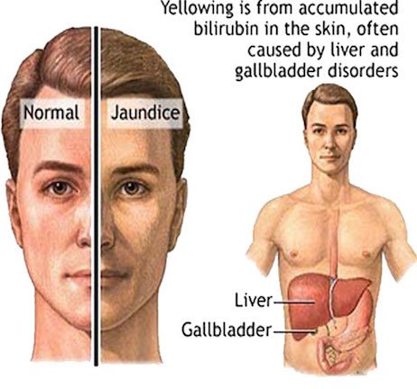 Micropathogene2's tweet image. #Microbial #Gilbert's syndrome is an inherited condition that's often discovered by accident, such as when someone has a #blood test. It occurs due to a defect in the processing of bilirubin by the liver. #FF
Visit us at: omicsonline.org/journal-microb…